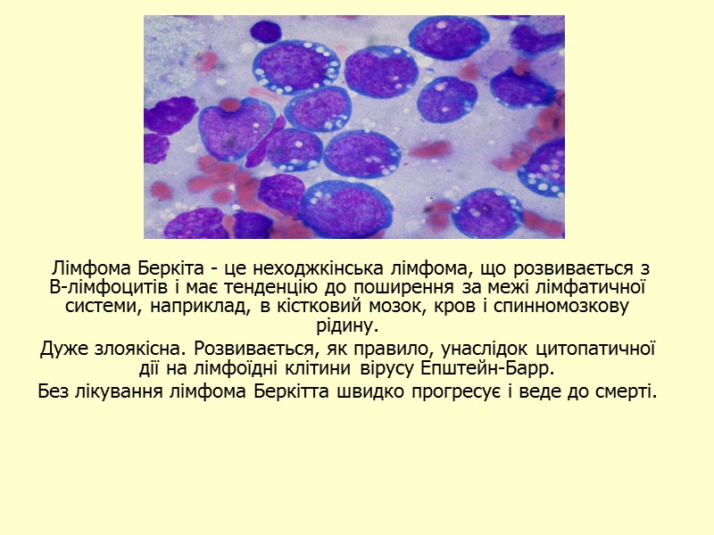 Лімфома Беркіта - це неходжкінська лімфома, що розвивається з В-лімфоцитів і має тенденцію до